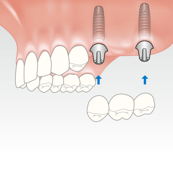 Illustration of dental implants