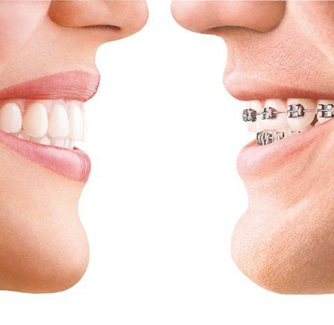 braces-886x647 braces-886x647