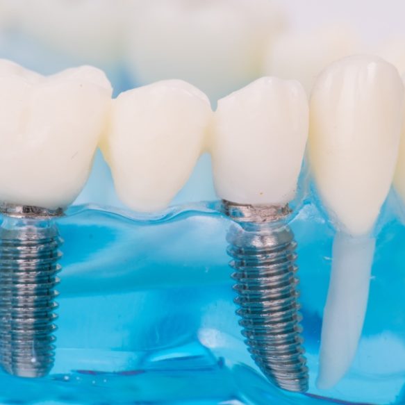 Dental implants